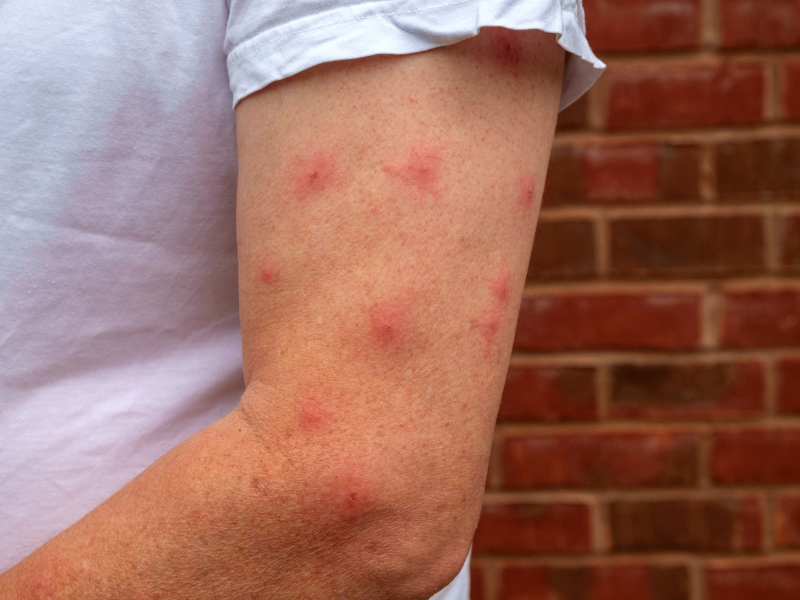 How to Determine Different Type of Bug Bites